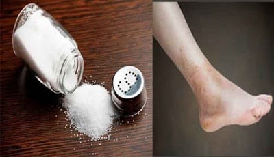 Penyakit akibat konsumsi garam berlebih