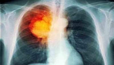 Gambar kanker paru-paru