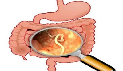 Ilustrasi cacing parasit dalam usus