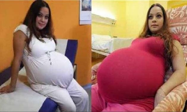 Wanita lahir bayi kembar lima