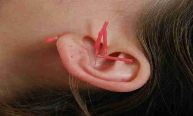 Diet akupunktur telinga